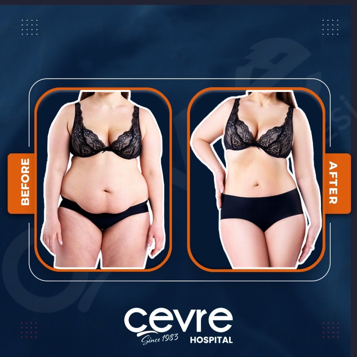 نتائج شفط دهون البطن قبل وبعد في Adem and Havva Medical Center، تنسيق القوام