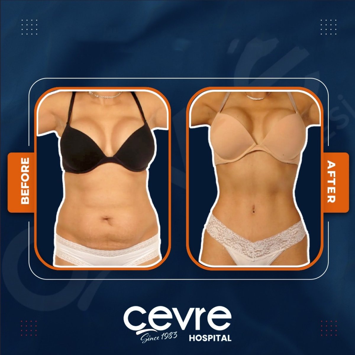 Resultados de liposucción abdominal antes y después en Adem and Havva Medical Center, cintura más delgada