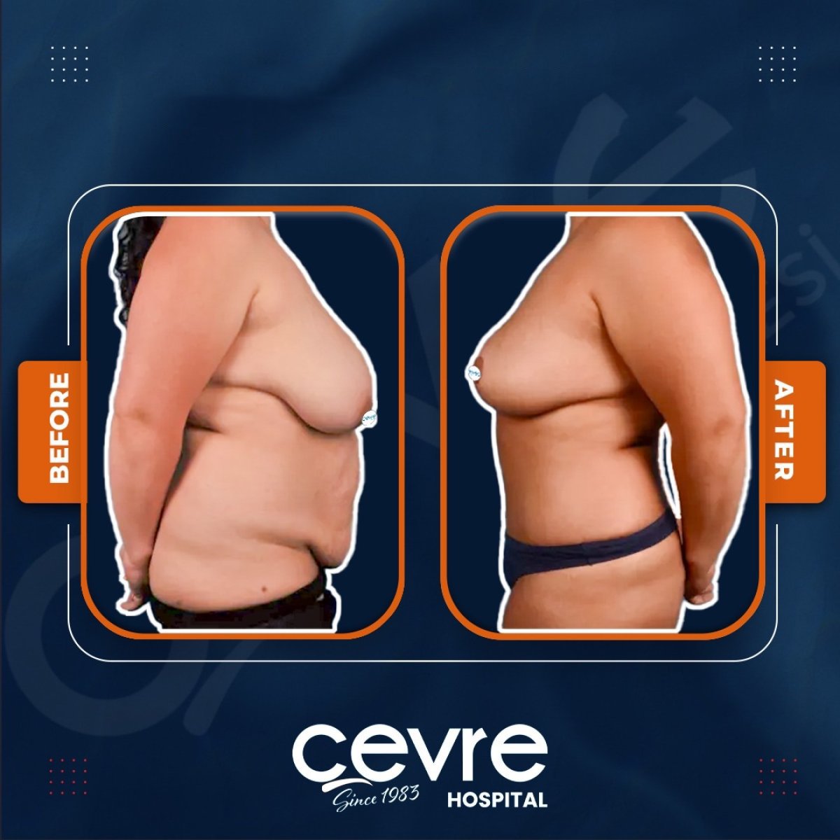 نتائج شفط دهون البطن قبل وبعد في Adem and Havva Medical Center، تنسيق الجسم