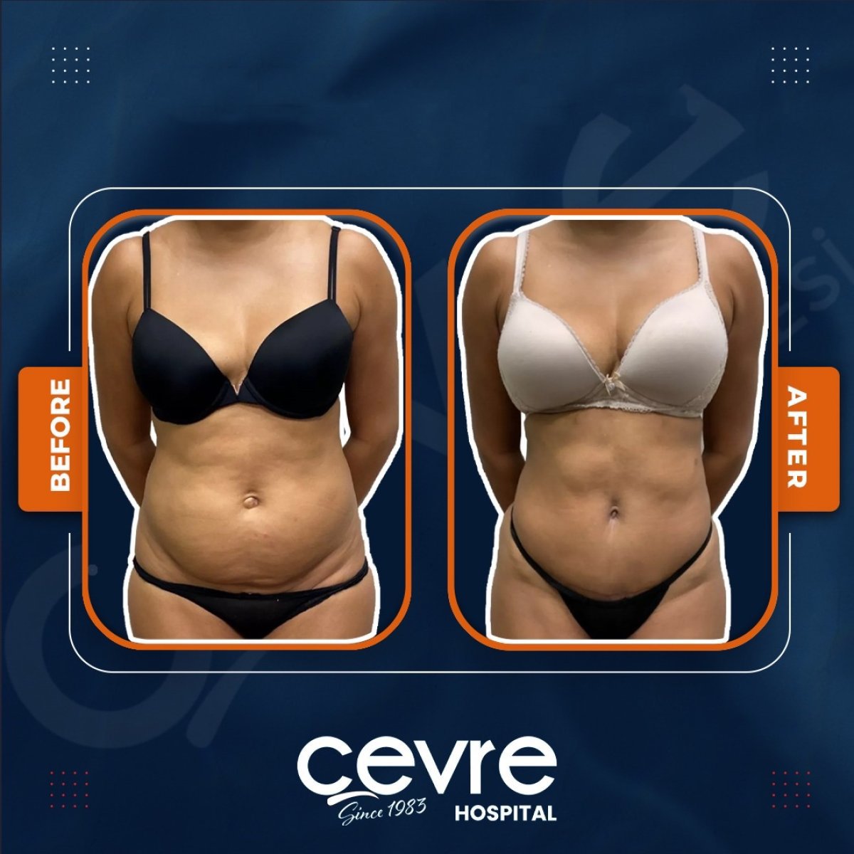 نتائج شفط دهون البطن قبل وبعد في Adem and Havva Medical Center، خصر أنحف