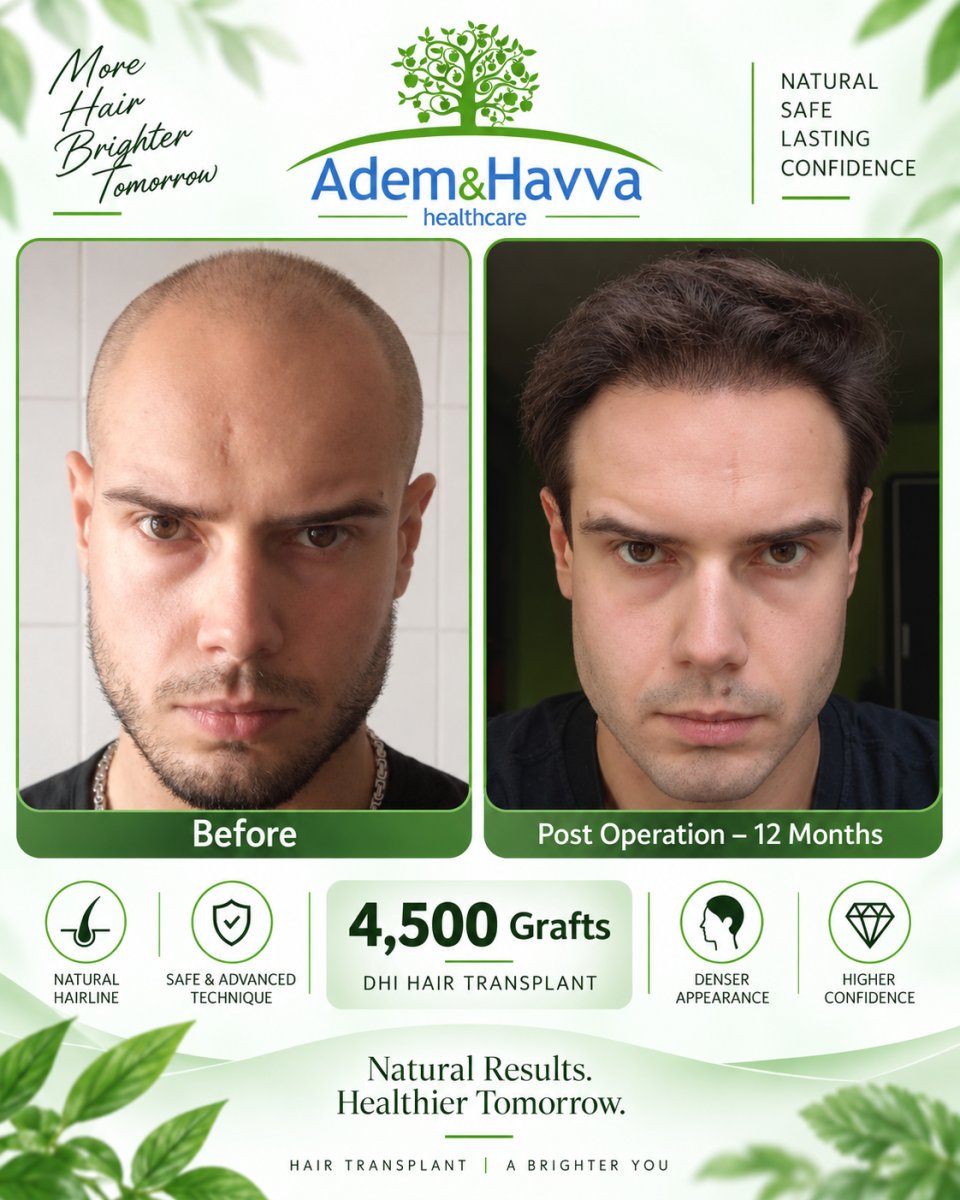 Resultados antes y después de trasplante capilar DHI en Adem and Havva Medical Center, 4500 injertos
