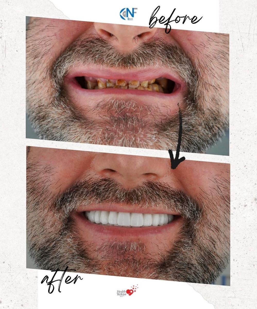 نتائج قبل وبعد زراعة الأسنان في Nifa Dent International – ابتسامة مستعادة