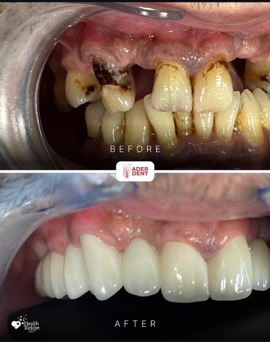 نتائج زراعة الأسنان قبل وبعد في عيادة Ader Dent، استعادة الابتسامة