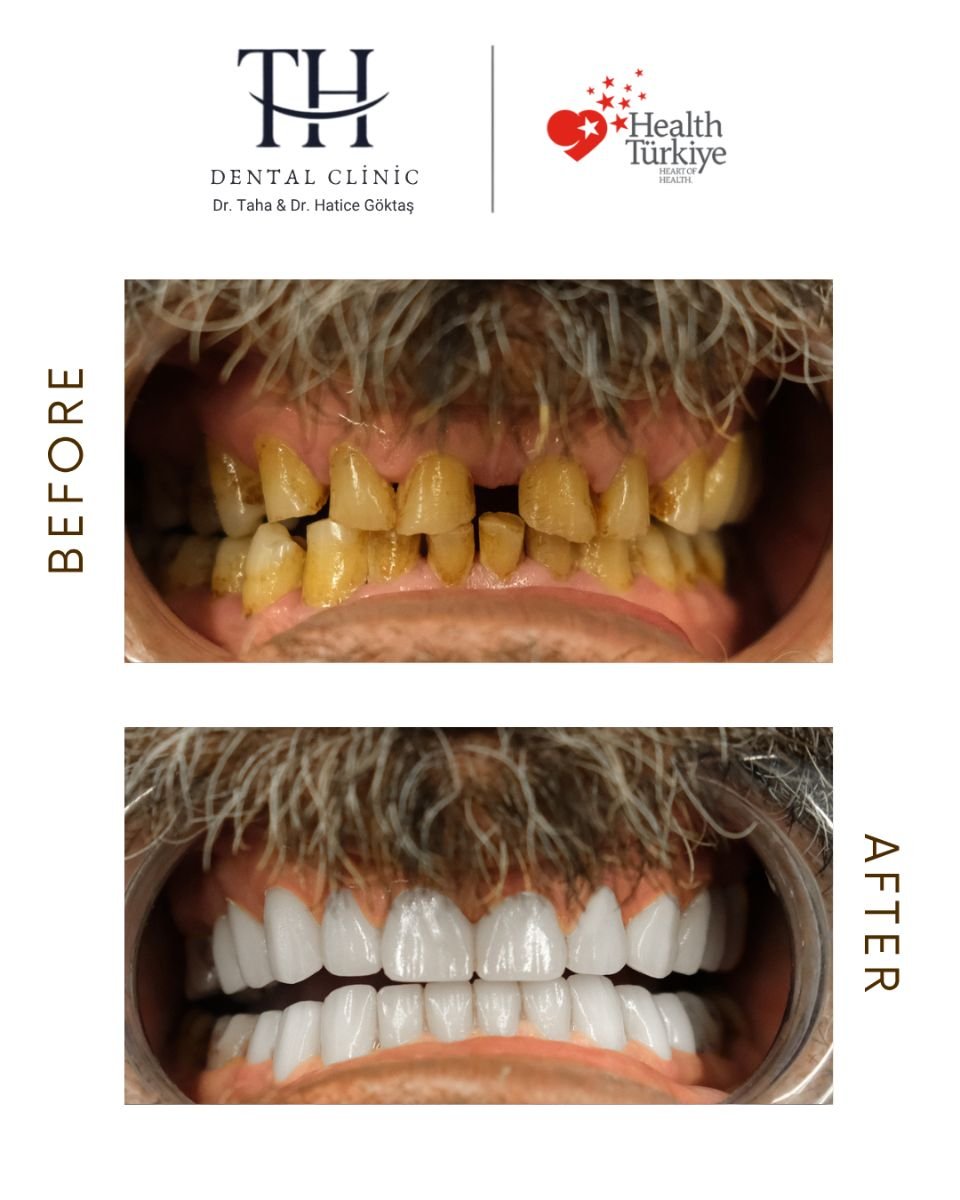 نتائج زراعة الأسنان قبل وبعد في عيادة TH Dental Clinic – ابتسامة بيضاء مستعادة