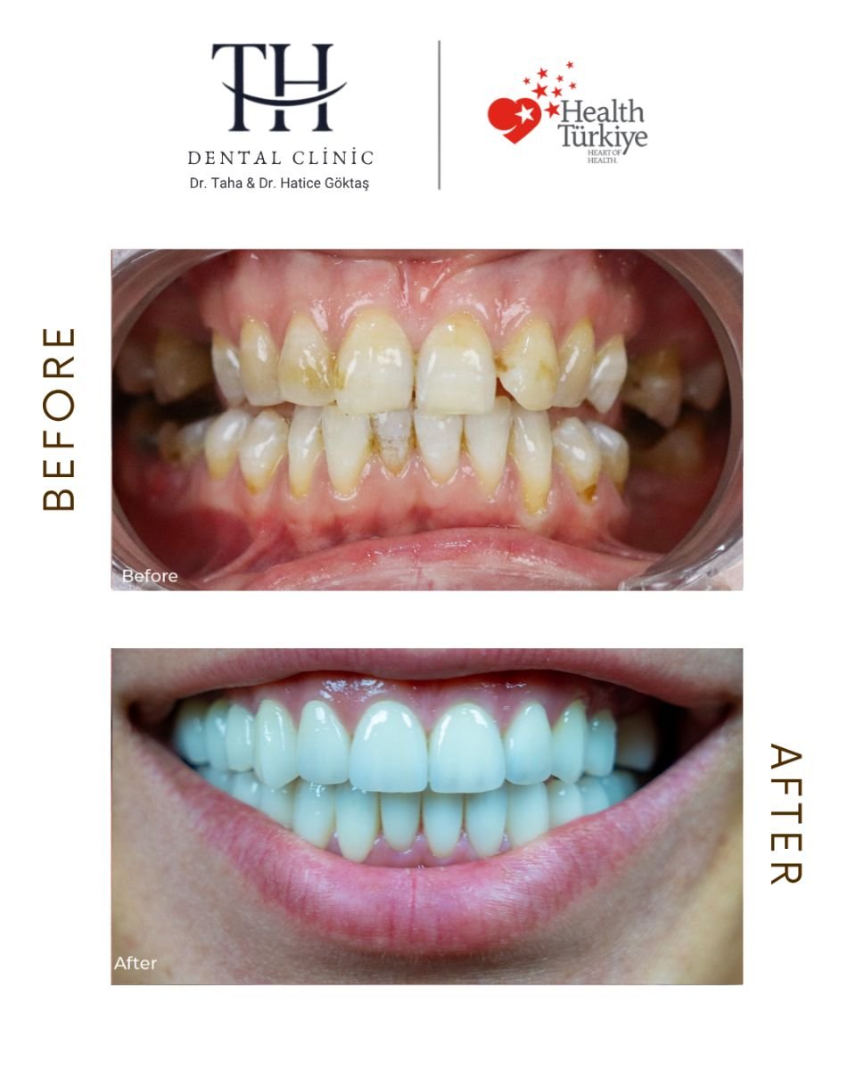 نتائج زراعة الأسنان قبل وبعد في عيادة TH Dental Clinic – ابتسامة مستعادة