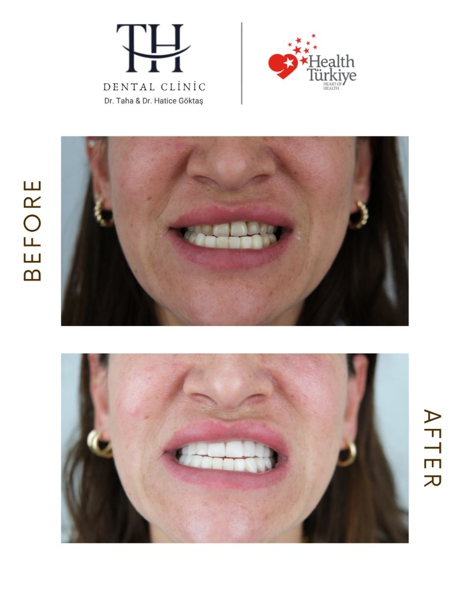 نتائج زراعة الأسنان قبل وبعد في TH Dental Clinic – ابتسامة محسنة وأسنان أكثر بياضًا