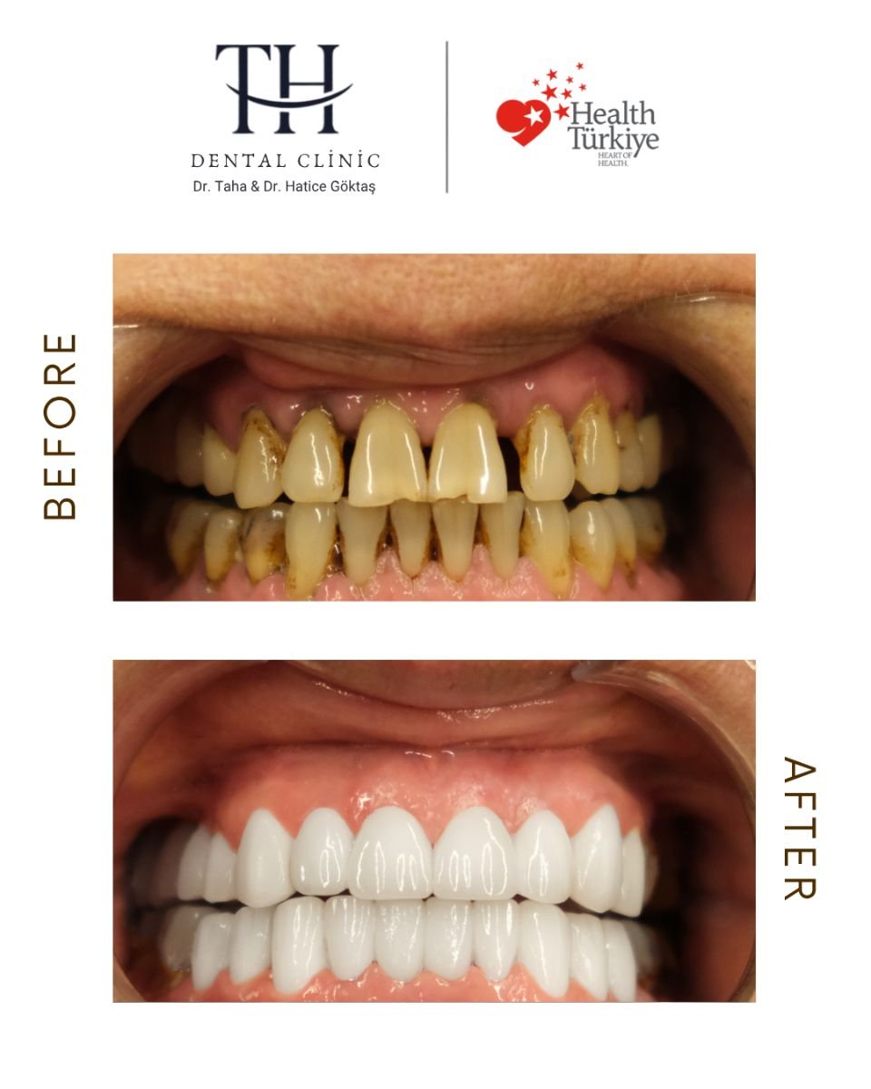 نتائج زراعة الأسنان قبل وبعد في عيادة TH Dental Clinic – ابتسامة بيضاء مستعادة