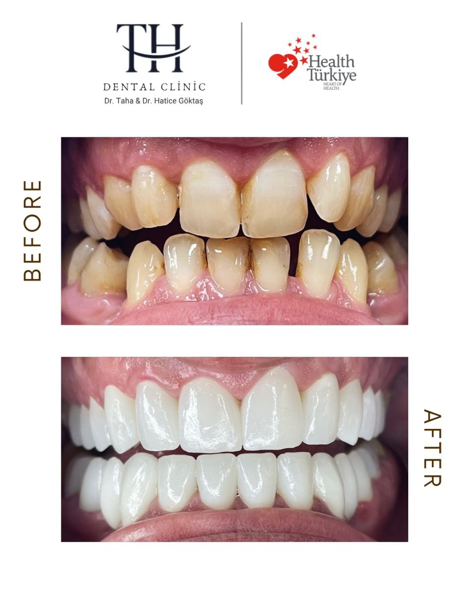 نتائج زراعة الأسنان قبل وبعد في عيادة TH Dental Clinic – ابتسامة مستعادة