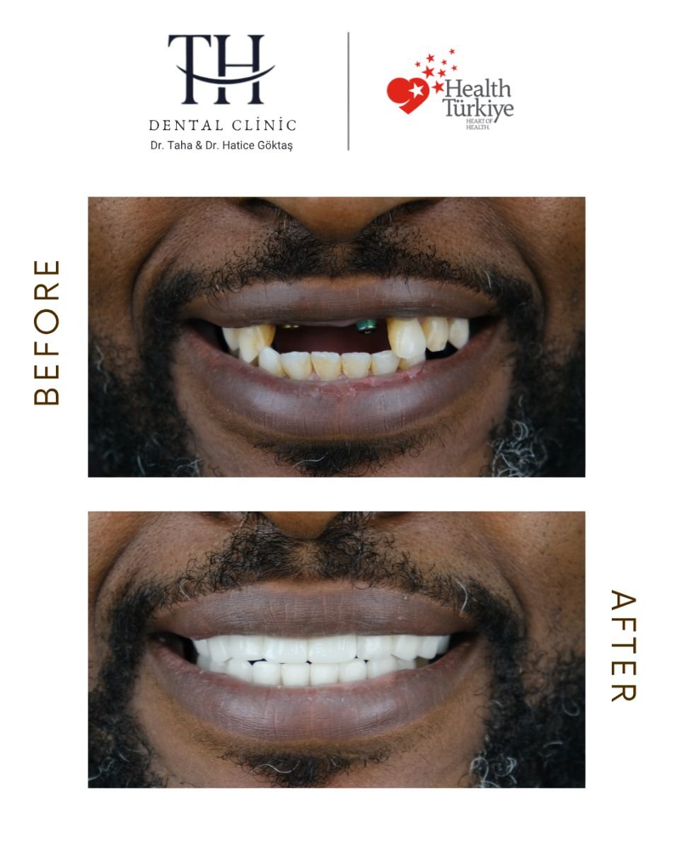 نتائج زراعة الأسنان قبل وبعد في عيادة TH Dental Clinic – ابتسامة مستعادة
