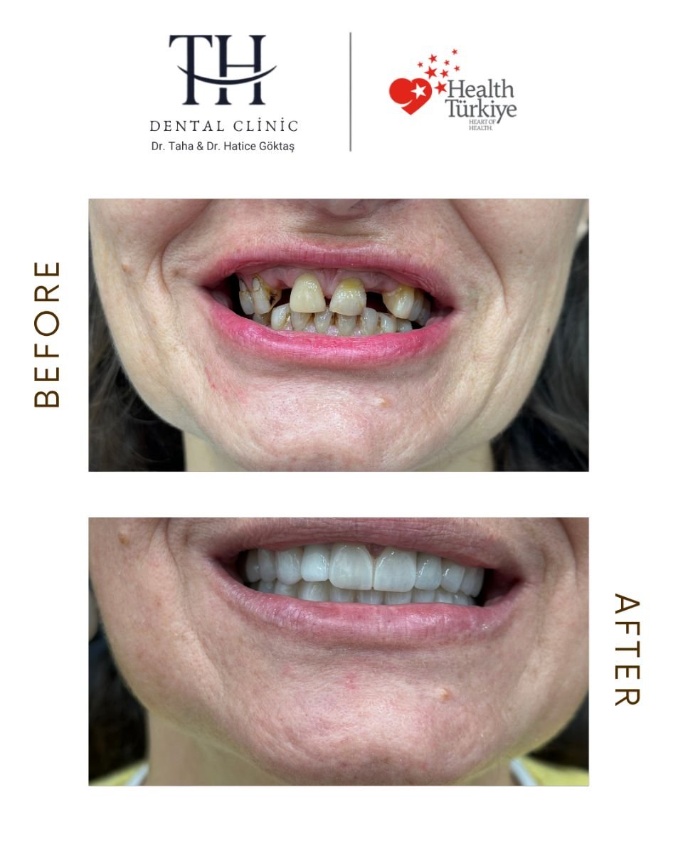نتائج زراعة الأسنان قبل وبعد في عيادة TH Dental Clinic – ابتسامة مستعادة