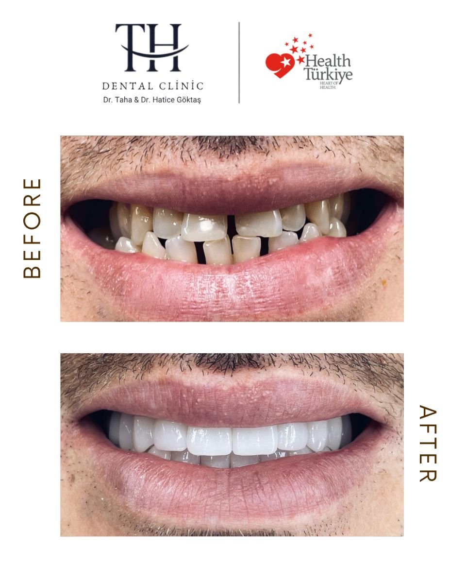 نتائج زراعة الأسنان قبل وبعد في عيادة TH Dental Clinic – ابتسامة وأسنان متناسقة