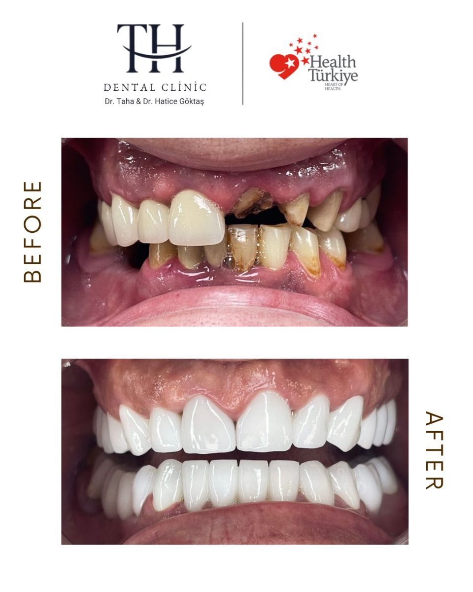 نتائج زراعة الأسنان قبل وبعد في عيادة TH Dental Clinic – ابتسامة مستعادة