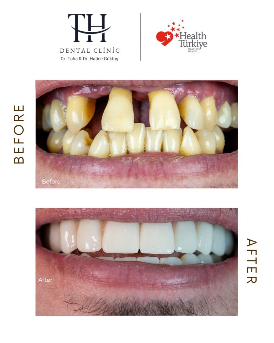 نتائج زراعة الأسنان قبل وبعد في عيادة TH Dental Clinic – ابتسامة مستعادة