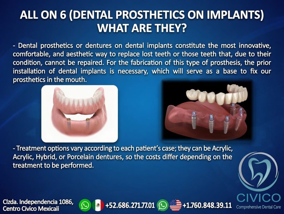 نتيجة تركيب أسنان All on 6 على زرعات في CIVICO DENTAL CARE MEXICALI، استعادة كاملة للفك