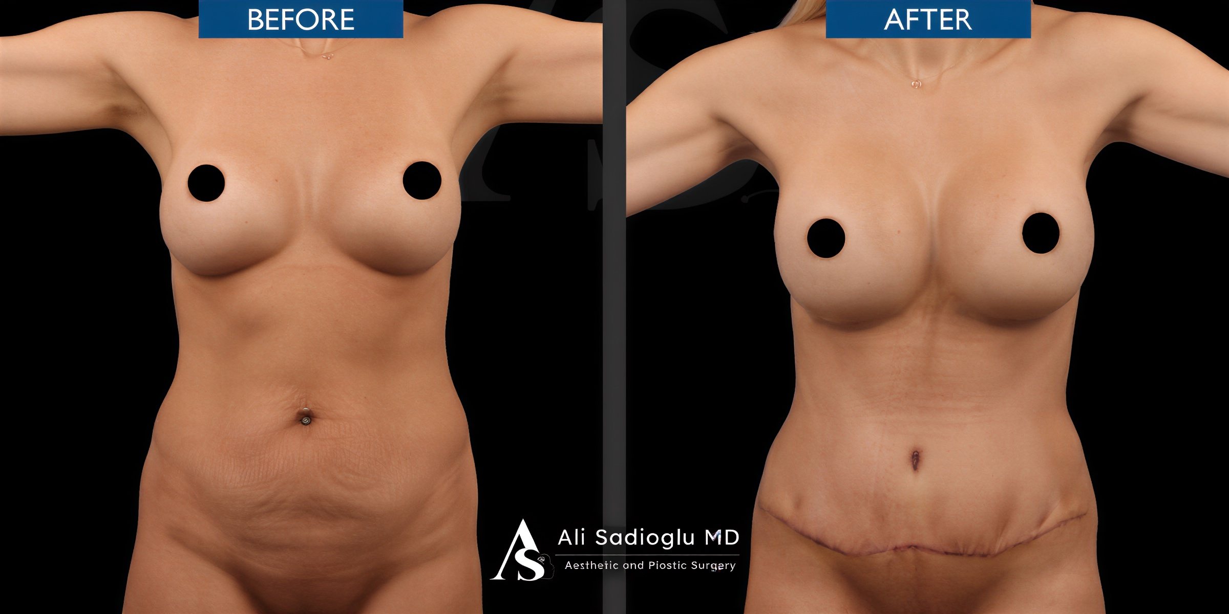 Resultados de abdominoplastia antes y después en Dr. Safa Manav Clinic con abdomen plano