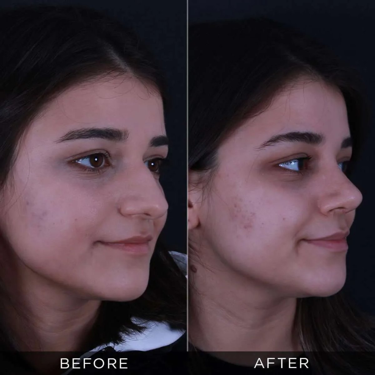 Resultados de rinoplastia antes y después en Dr. Hasan Duygulu Private Practice, remodelación nasal