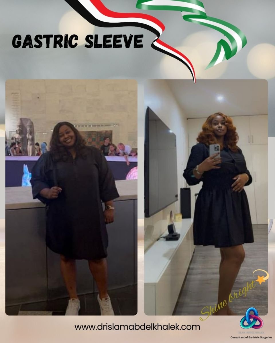 Before and after gastric sleeve results at Dr. Islam Abdelkhalek's Clinic, visible weight loss