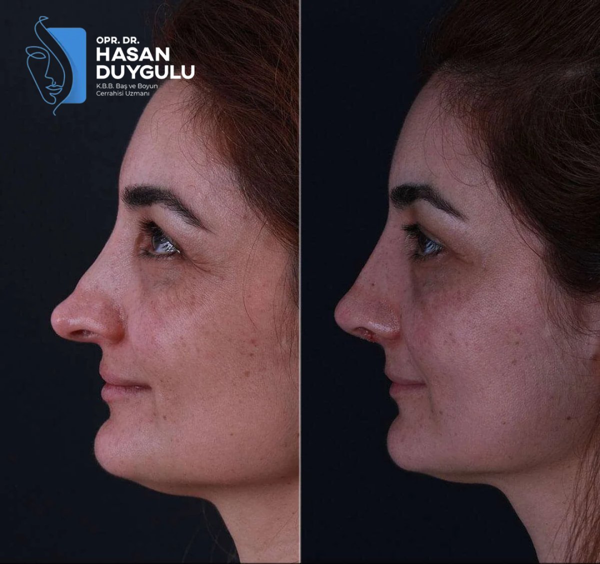 Before and after rhinoplasty results at Dr. Hasan Duygulu Private Practice, nose reshaping