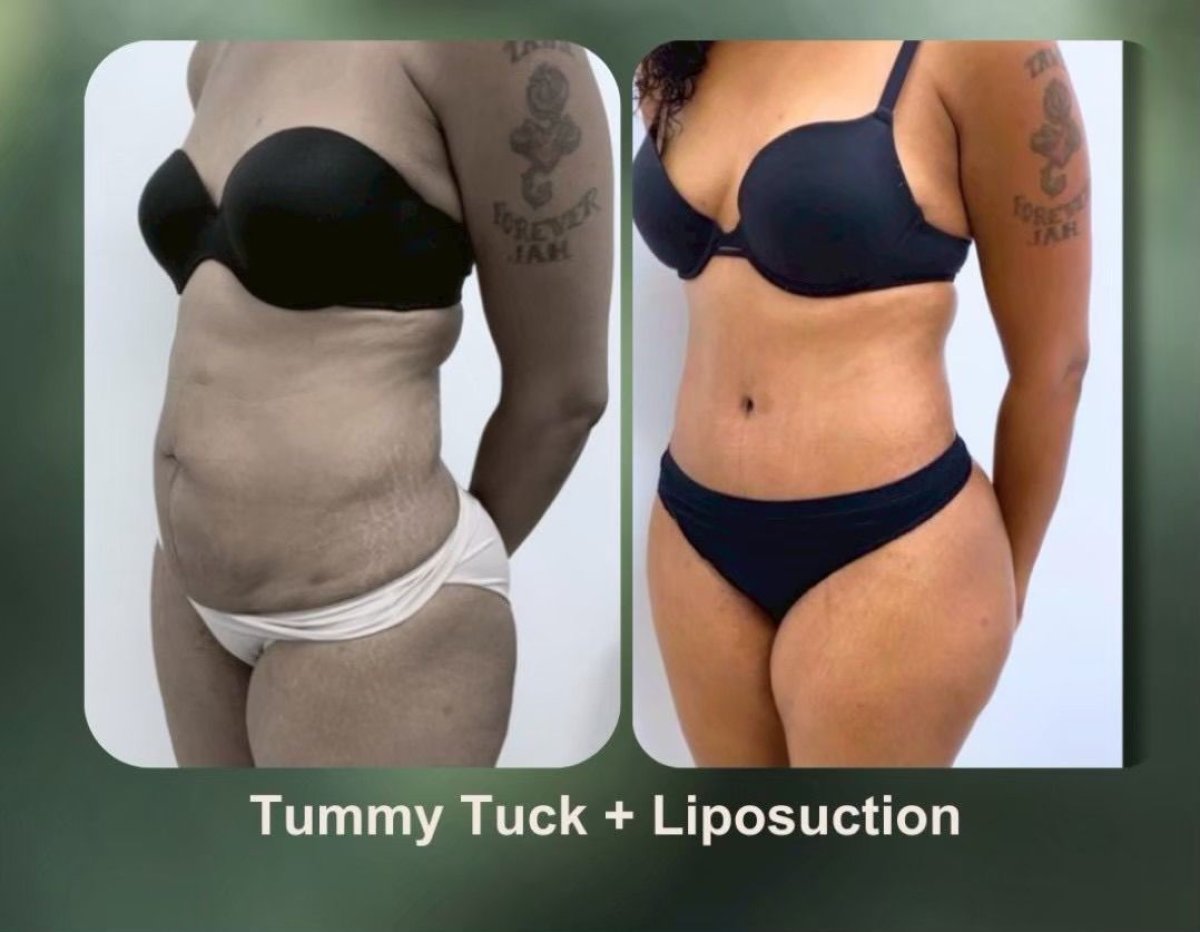 Before and after tummy tuck with liposuction results at DGB Clinic, improved body contour