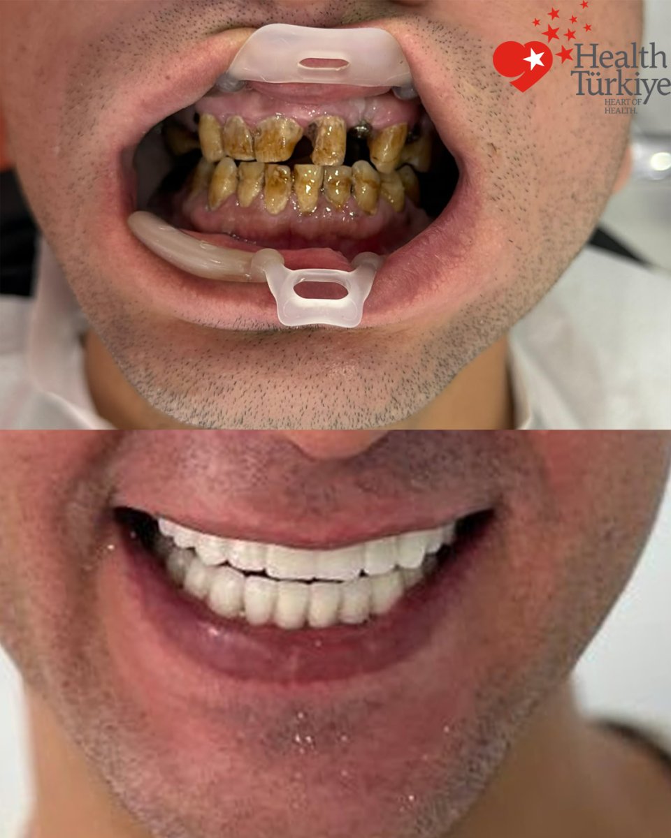 نتائج زراعة الأسنان قبل وبعد في عيادة Health Turkiye – ابتسامة بيضاء مستعادة