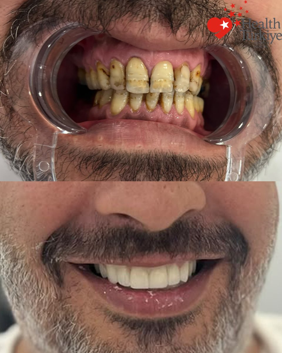 نتائج زراعة الأسنان قبل وبعد في Health Turkey، ابتسامة محسنة وأسنان أكثر بياضًا