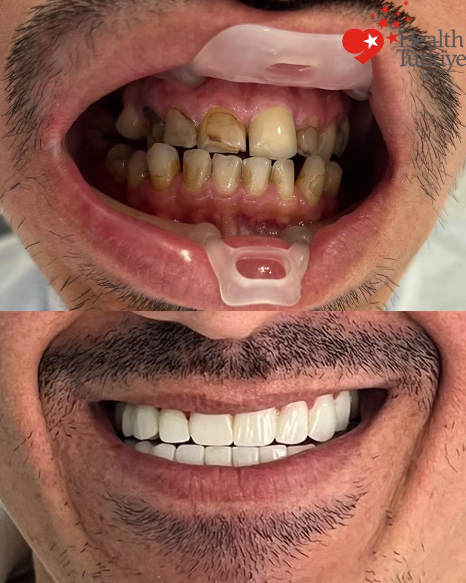 نتائج زراعة الأسنان قبل وبعد في Health Turkiye – ابتسامة مستعادة