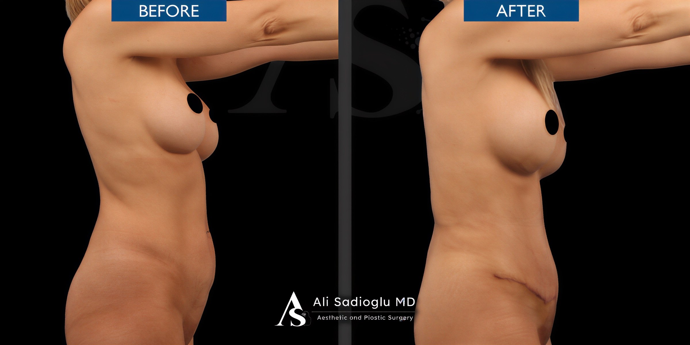 Resultados de abdominoplastia antes y después en Dr. Safa Manav Clinic – abdomen plano