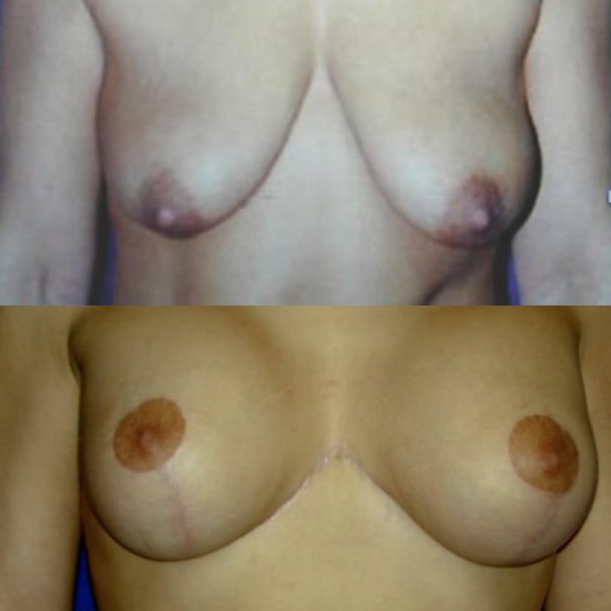 Before and after breast implants with lift at Memorial Göztepe Hospital, enhanced breast shape result