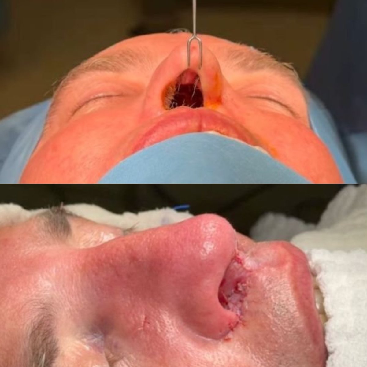 نتائج عملية تجميل الأنف قبل وبعد في مستشفى ميموريال أنقرة، إعادة تشكيل الأنف