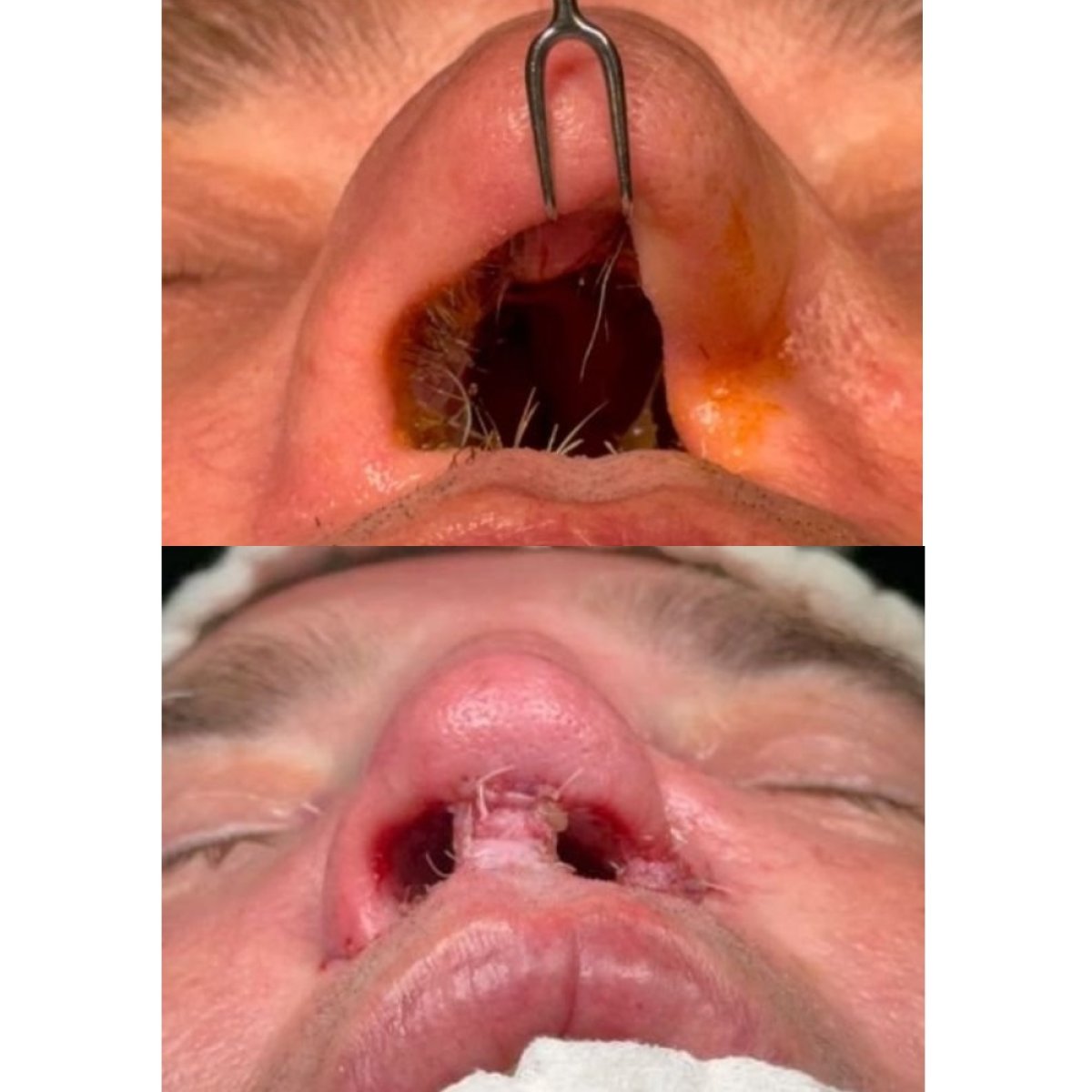 نتائج عملية تجميل الأنف قبل وبعد في مستشفى ميموريال أنقرة، تحسين هيكل الأنف