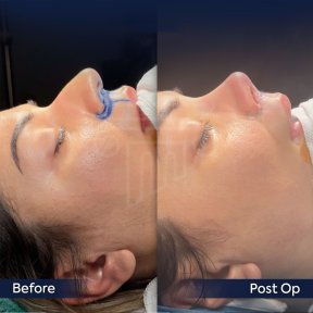 Premium Rhinoplasty (nose job) All Included - photo 4