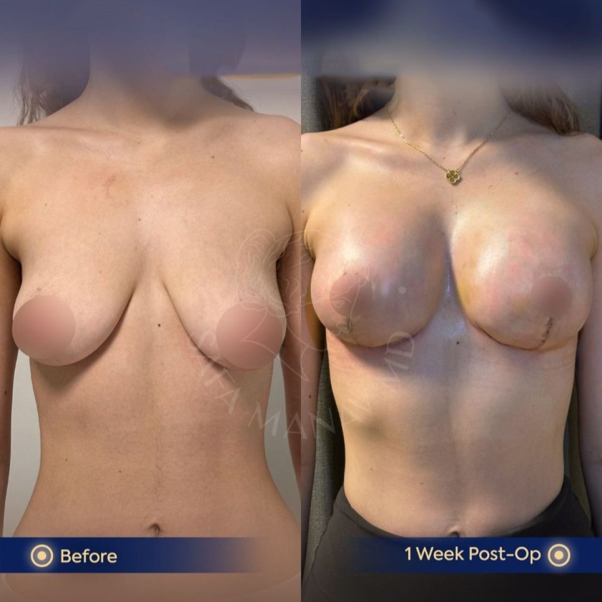 Resultados de lifting de senos antes y después en Dr. Safa Manav Clinic, cambio visible
