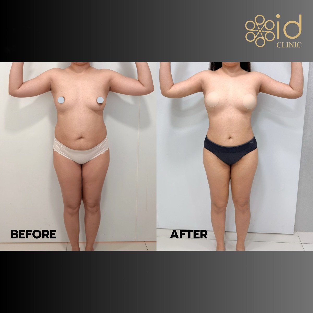 Resultados de liposucción 360 antes y después en ID Clinic Bangkok, mejora visible del contorno corporal