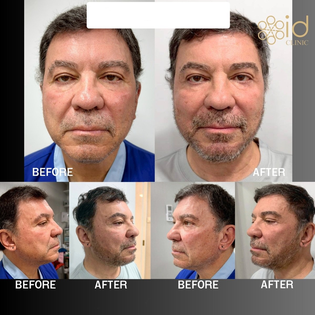 Before and after beard transplant results at ID Clinic Bangkok, fuller facial hair achieved