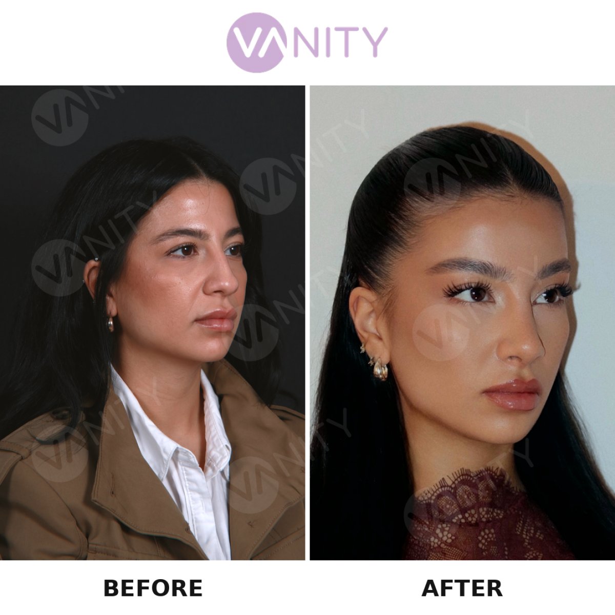 نتائج عملية تجميل الأنف قبل وبعد في Vanity Cosmetic Surgery Hospital، شكل أنف مصقول