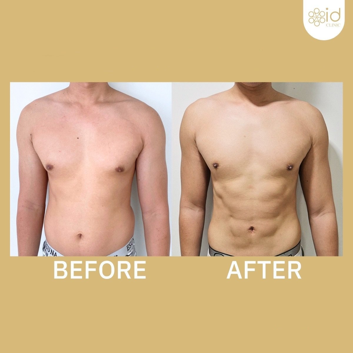 نتائج شفط الدهون 360 قبل وبعد في ID Clinic Bangkok، تحسين شكل جسم الرجل