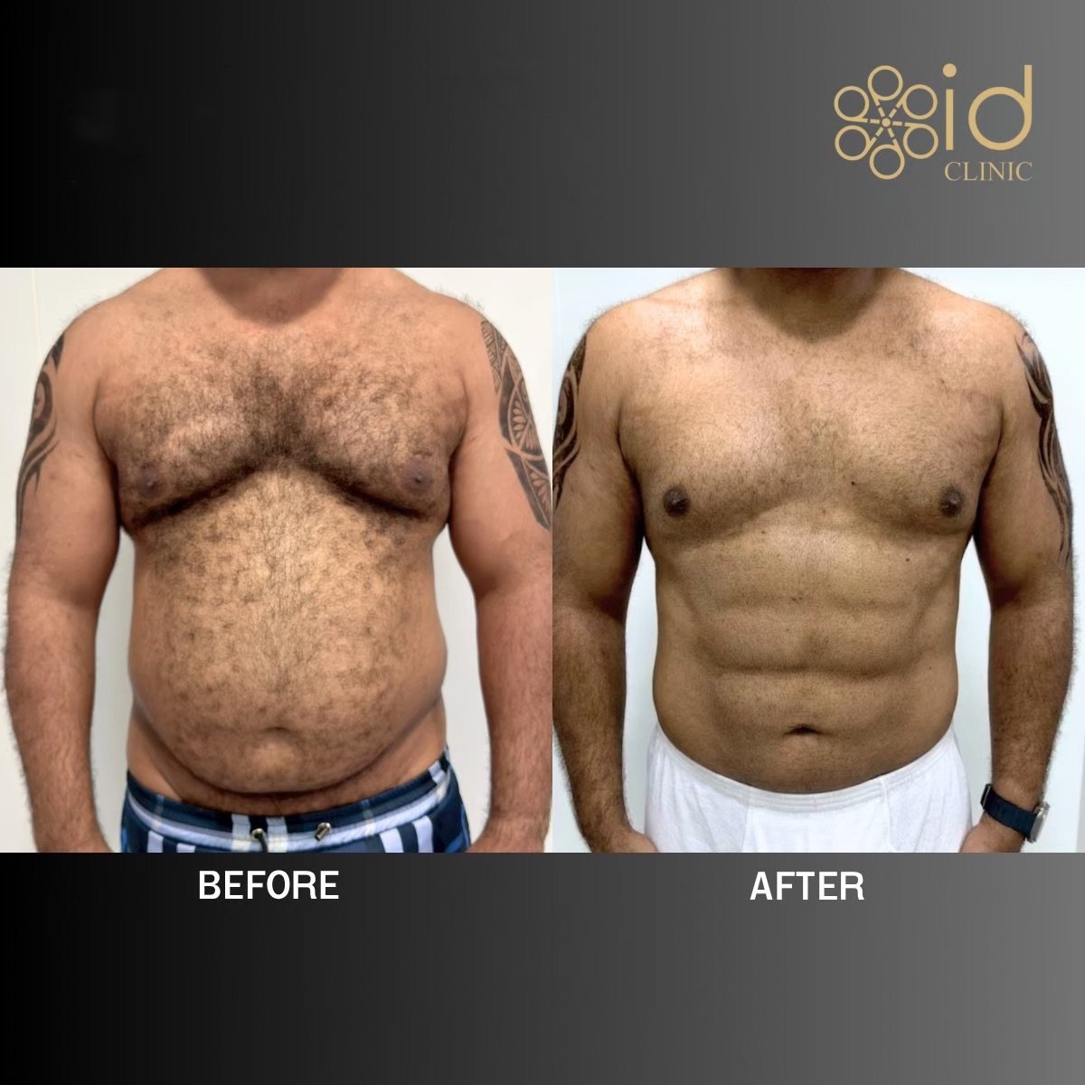نتائج شفط الدهون 360 قبل وبعد في ID Clinic Bangkok، تحسين شكل جسم الرجل
