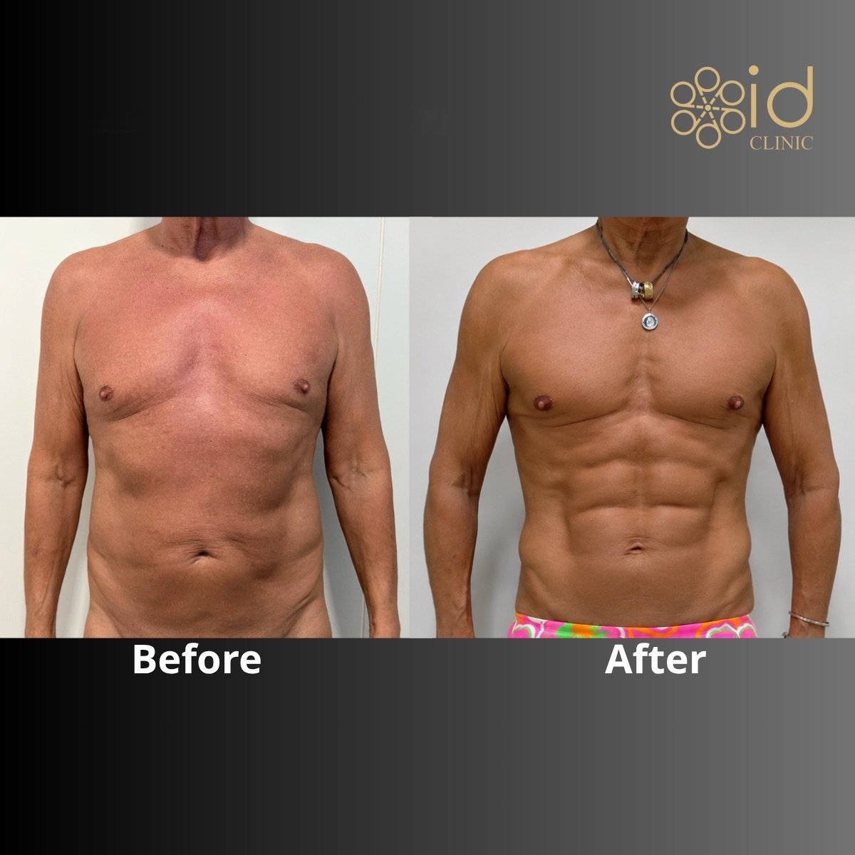 نتائج شفط الدهون 360 قبل وبعد في ID Clinic Bangkok، تحديد واضح لجسم الرجل