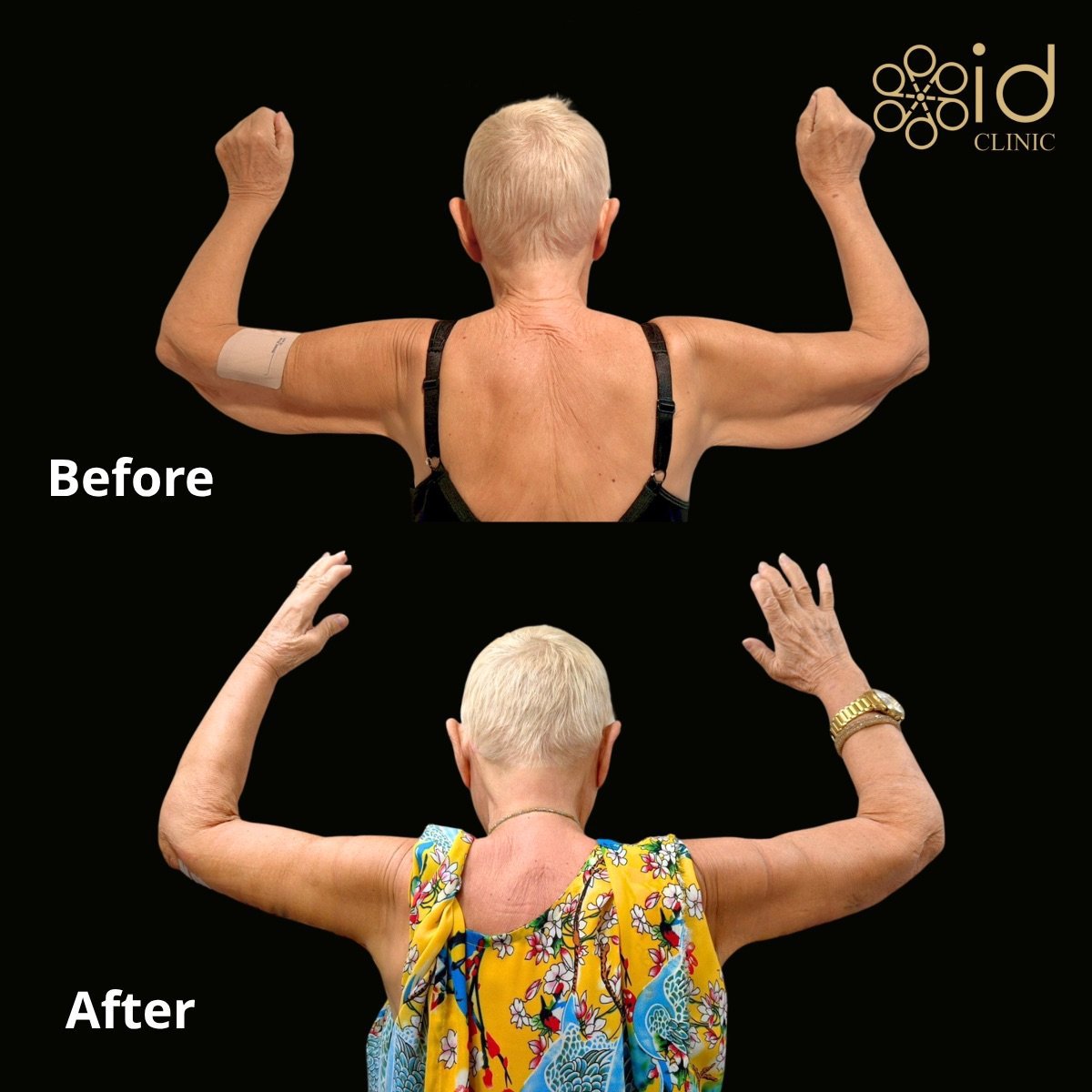 Resultados de lifting de brazos (braquioplastia) antes y después en ID Clinic Bangkok, mejor contorno
