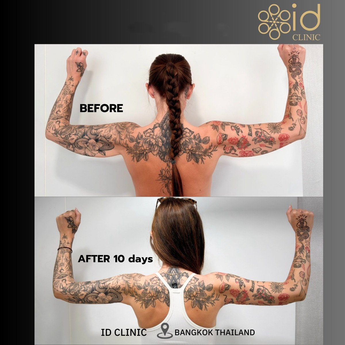 Resultados antes y después de lifting de brazos (braquioplastia) en ID Clinic Bangkok, 10 días