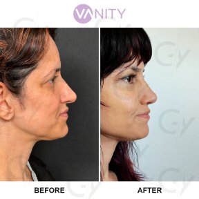 Standard Rhinoplasty (nose job) - photo 5