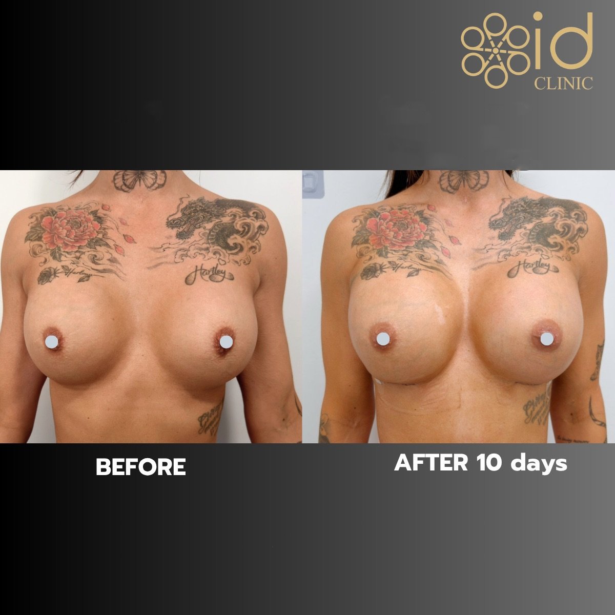 نتائج تكبير الثدي قبل وبعد في ID Clinic Bangkok، تحسن ملحوظ بعد 10 أيام
