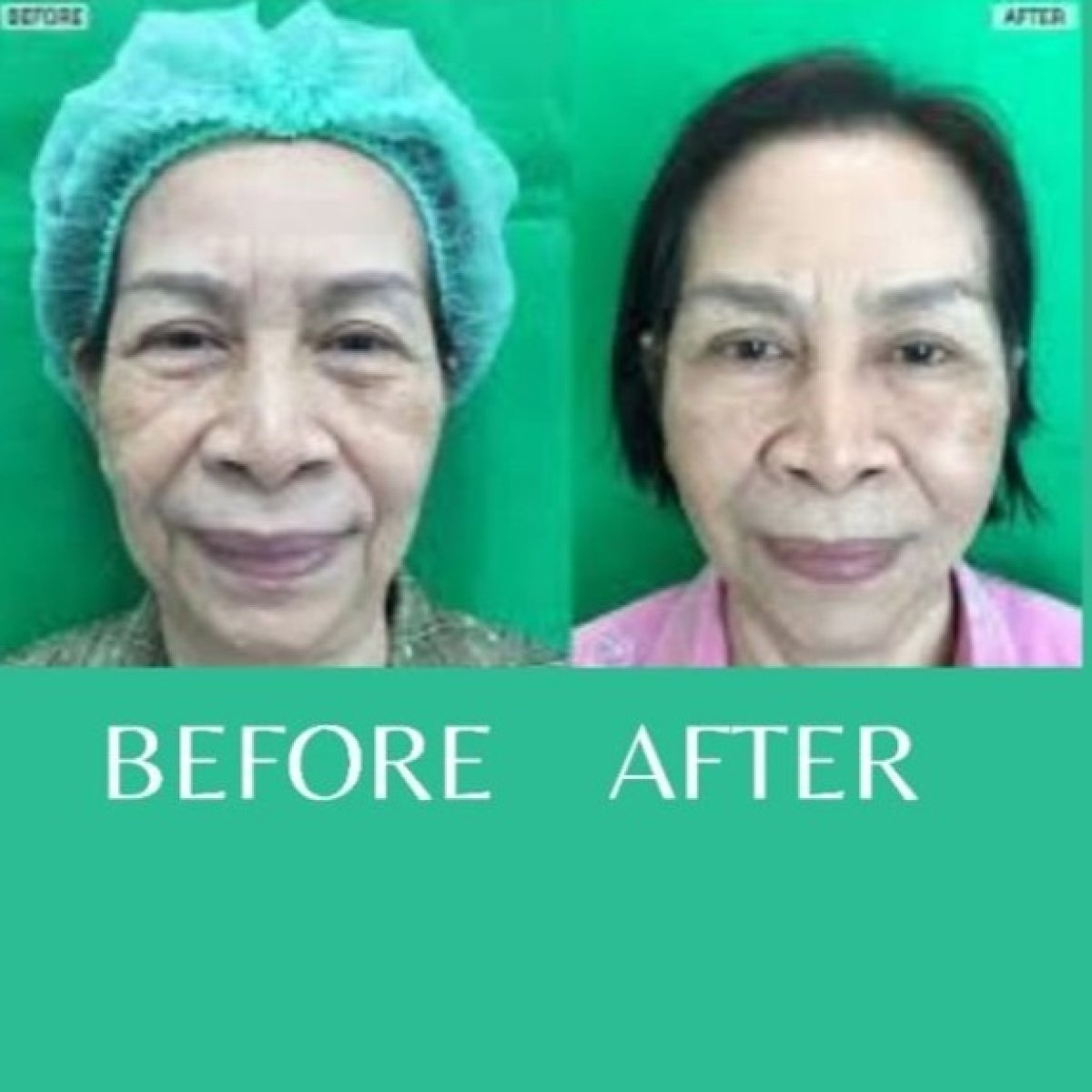 Resultados de minilifting facial antes y después en ID Clinic Bangkok, rejuvenecimiento visible
