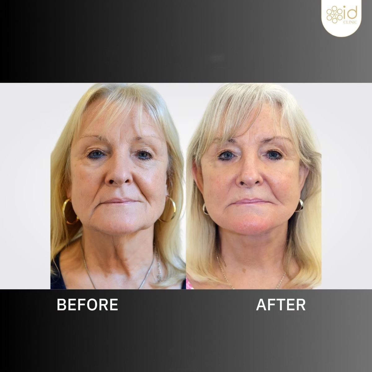 Resultados de minilifting facial antes y después en ID Clinic Bangkok, rejuvenecimiento visible