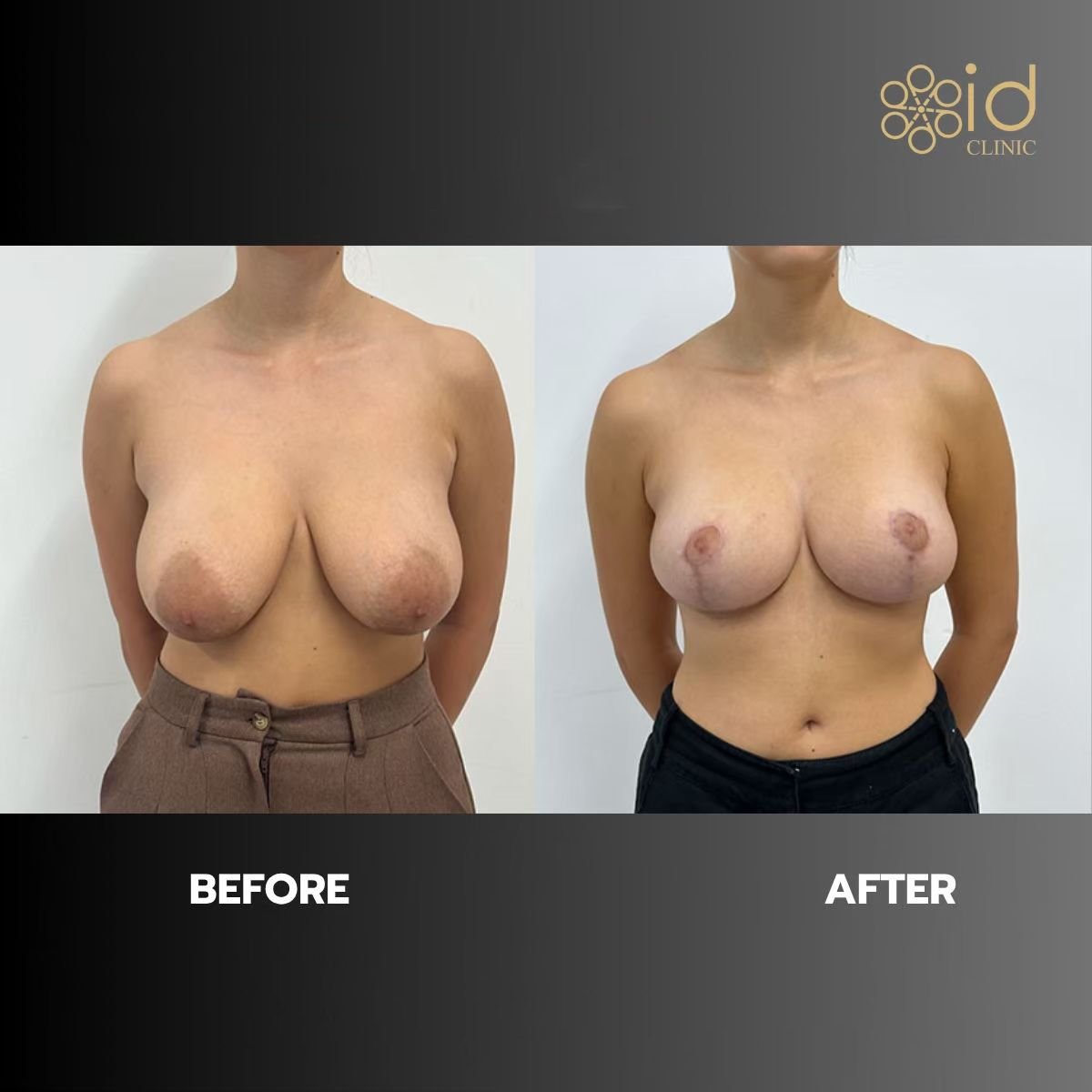 نتائج شد الثدي قبل وبعد في ID Clinic Bangkok، تحسين شكل ورفع الثدي