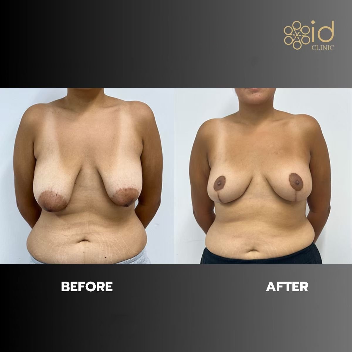 نتائج شد الثدي قبل وبعد في ID Clinic Bangkok، تحسين شكل وتناسق الثدي