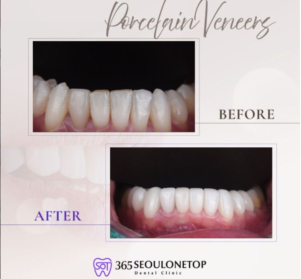 نتائج قبل وبعد قشور البورسلين في عيادة 365 Seoul OneTop Dental Clinic لتحسين الابتسامة