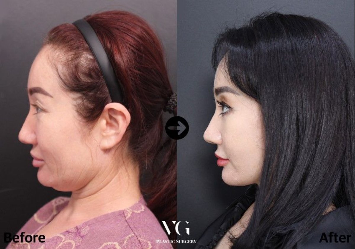 نتائج شد الوجه قبل وبعد في VG Plastic Surgery – تحسين واضح للفك والرقبة