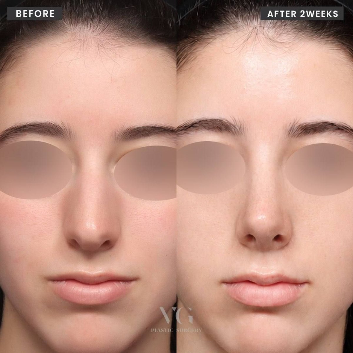 Before and after bulbous nose rhinoplasty result at VG Plastic Surgery, 2 weeks post-op