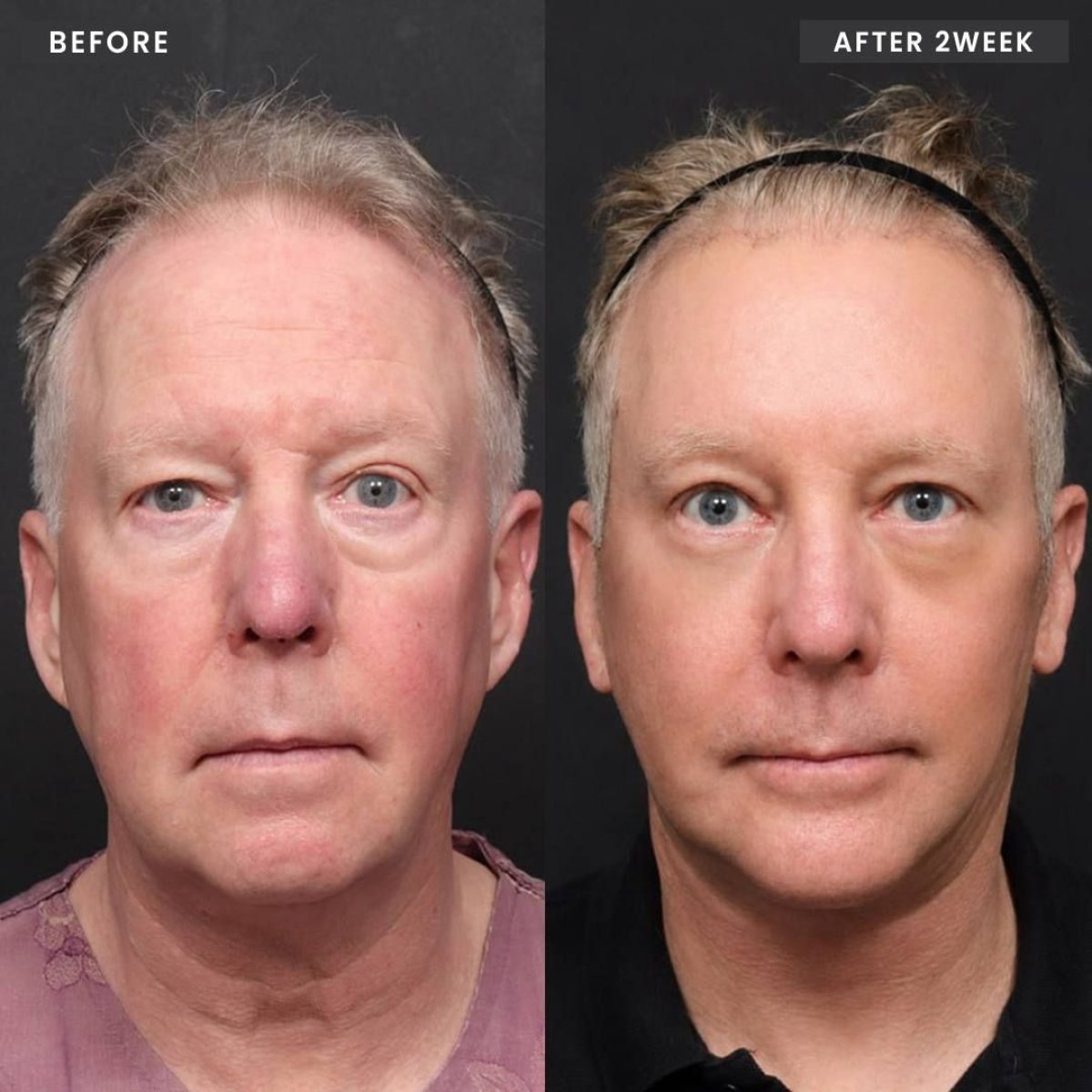 نتائج قبل وبعد نقل دهون الوجه في VG Plastic Surgery مع تجديد ملحوظ